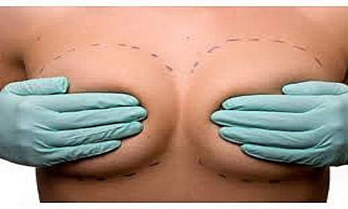 Cómo evitar una inflamación en las mamas tras una operación